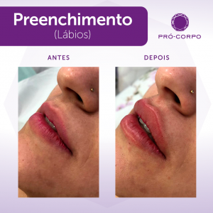 preenchimento labial antes e depois - Botox para volumizar os lábios