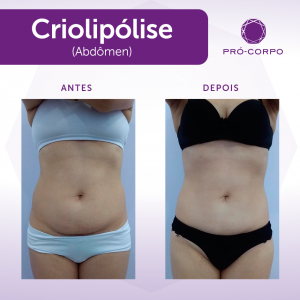 antes e depois de criolipólise para Gordura Localizada