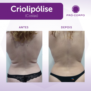 antes e depois de criolipólise para Gordura Localizada