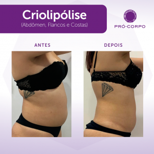 antes e depois de criolipólise para Gordura Localizada