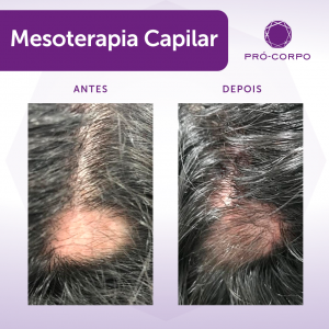 Antes e depois Mesoterapia Capilar