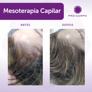 Antes e depois da Mesoterapia Capilar