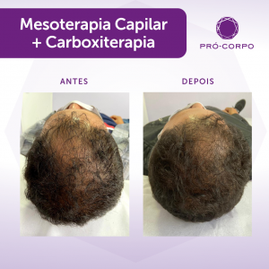 Antes e depois Mesoterapia Capilar 