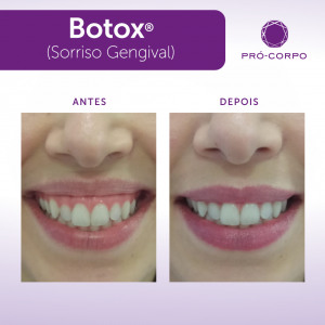 botox antes e depois procedimentos para noivas 