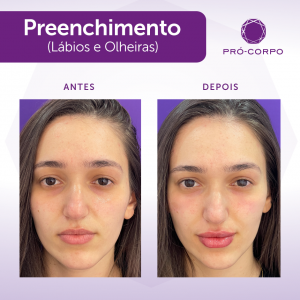 preenchimento antes e depois noivas