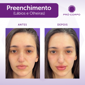 preenchimento antes e depois noivas 