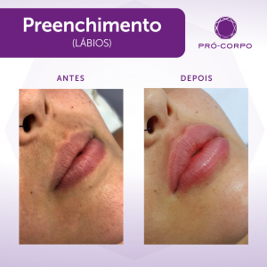 Preenchimento labial antes e depois procedimento noivas 