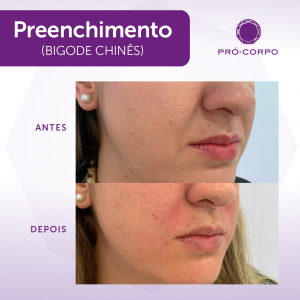 Antes e Depois Preenchimento Bigode Chinês