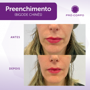 Antes e Depois Preenchimento Bigode Chinês