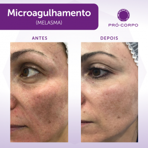 microagulhamento melasma