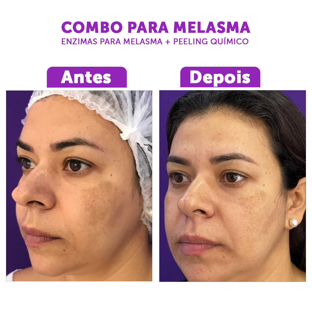 Enzima Melasma