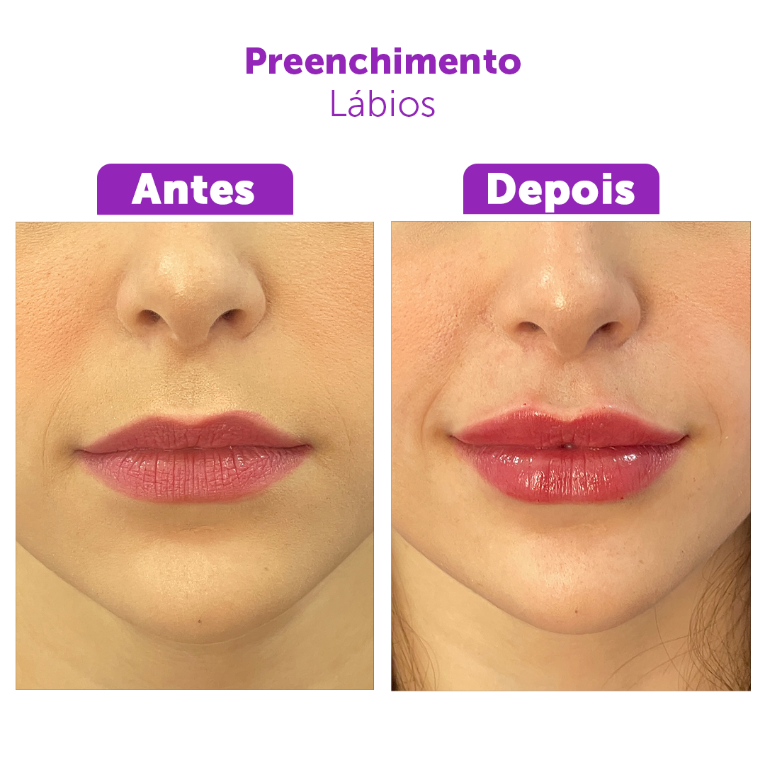 Preenchimento Labial