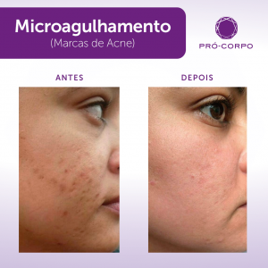 Microagulhamento para marcas de acne