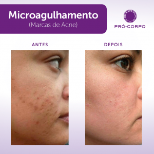 Microagulhamento para manchas faciais