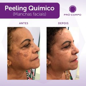 Peeling Químico para manchas faciais