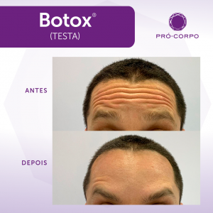 Botox na testa