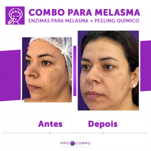 Enzima para Melasma