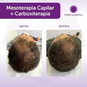 Carboxiterapia