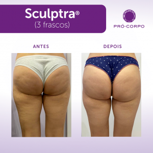 Sculptra para flacidez no bumbum