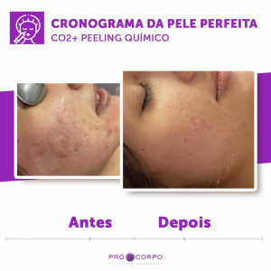 Tratamento cicatriz de acne