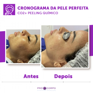 Tratamento cicatriz de acne