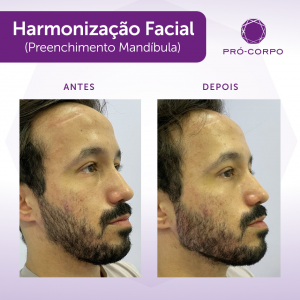 Harmonização Facial