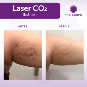 Laser de CO2 Fracionado