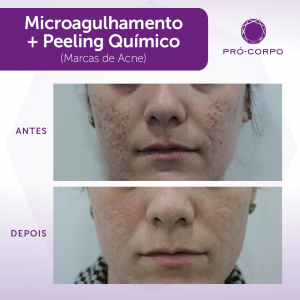 Peeling Químico