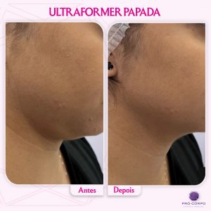 Papada: ultraformer