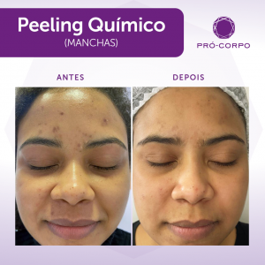 Menopausa e manchas faciais: Peeling químico