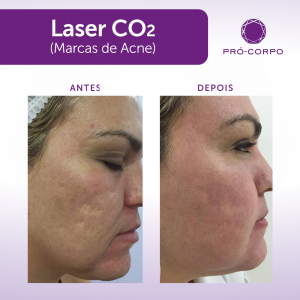 Manchas e cicatrizes de acne: Laser CO2 Fracionado