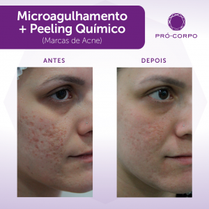 Manchas e cicatrizes de acne: Microagulhamento