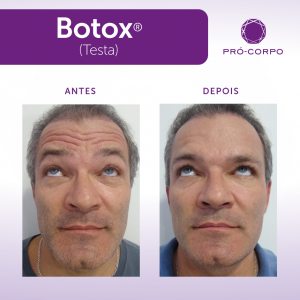 Botox