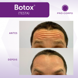 Botox