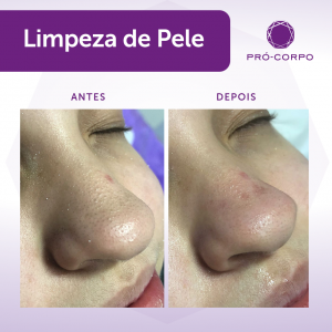 Limpeza de Pele