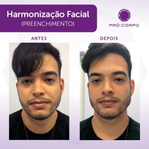 Harmonização Facial