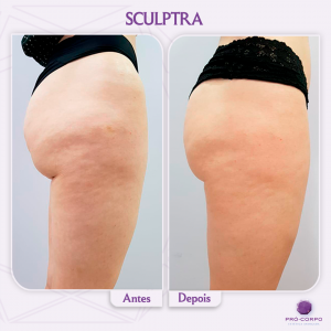 Sculptra