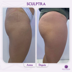 Sculptra 