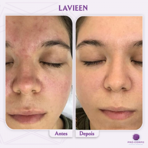 Lavieen Manchas de Acne