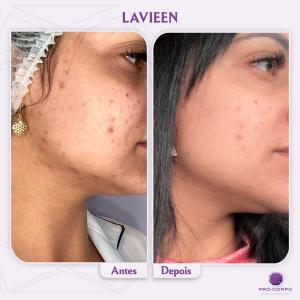 Lavieen Manchas de Acne