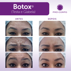 Botox