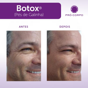 Botox