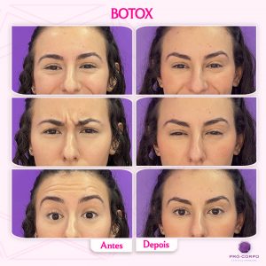 Botox