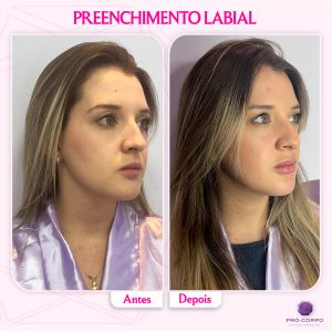 Preenchimento Labial