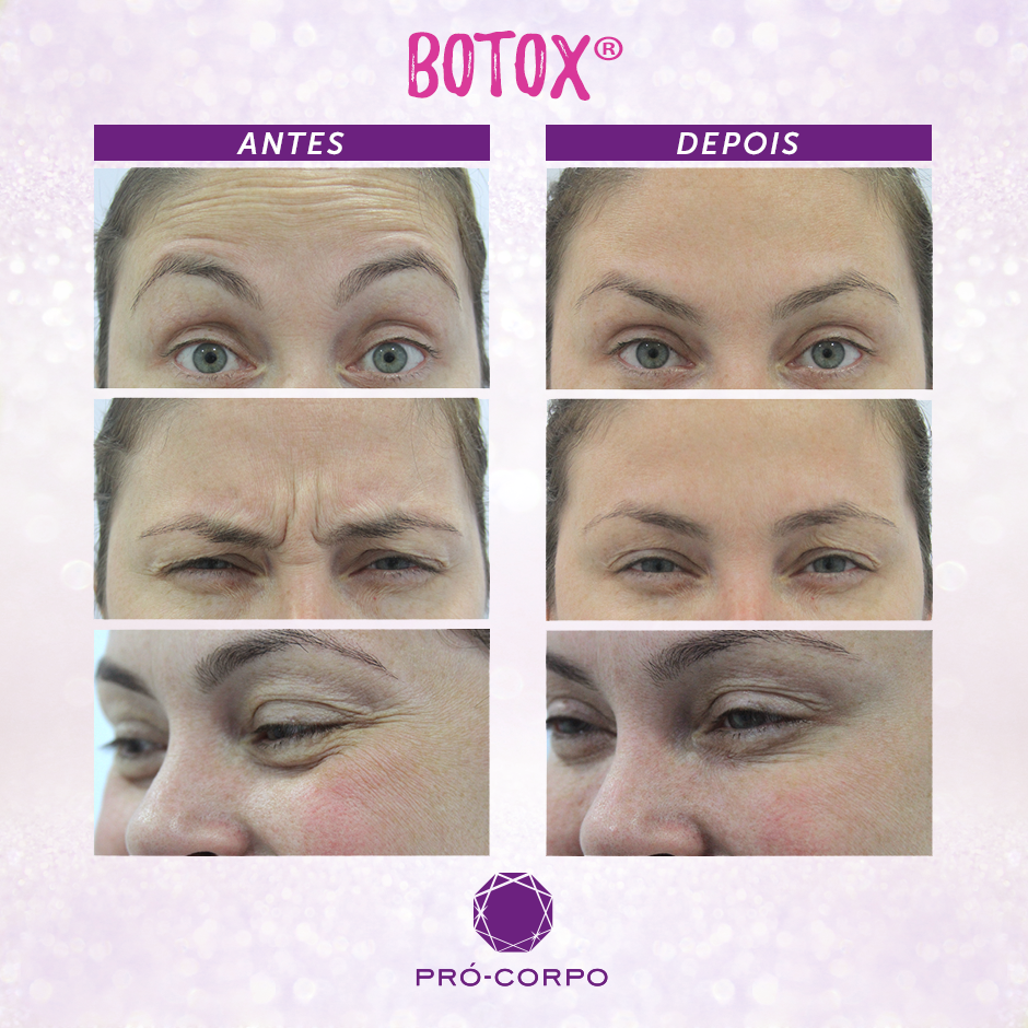 Botox ® Toxina botulínica para rugas e linhas de expressão PróCorpo