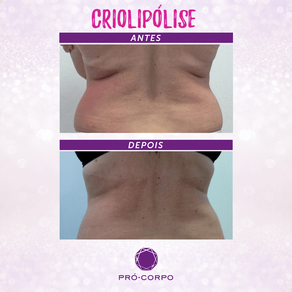Criolipólise: Tratamento de gordura localizada | Pró-Corpo