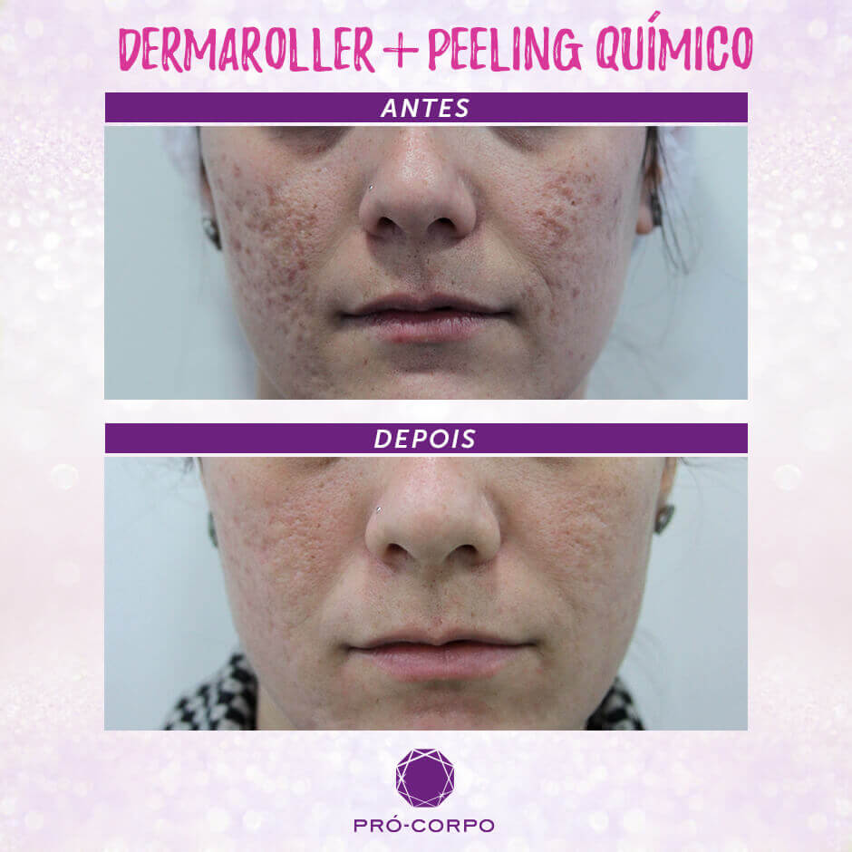 Dermaroller: Tratamento para cicatriz de acne  Pró-Corpo