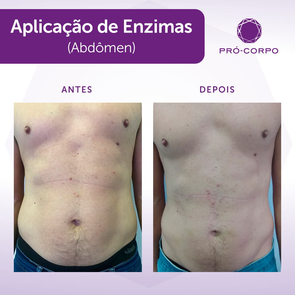 Aplicação De Enzimas Tratamento Para Gordura Localizada Pró Corpo