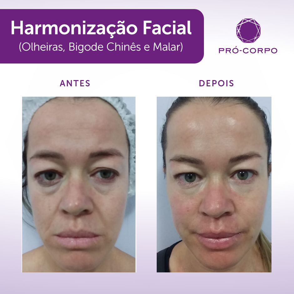 Harmonização Facial: Harmoniza e rejuvenesce o seu rosto