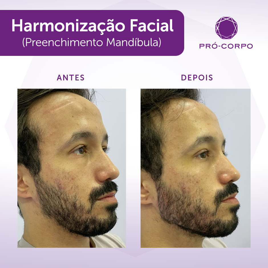 Harmonização Facial Masculina – Guia de Procedimentos Estéticos
